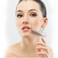 Acne & Blemishes (13)